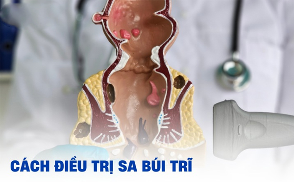 Cách chữa sa búi trĩ hiện nay tại Đắk Lắk