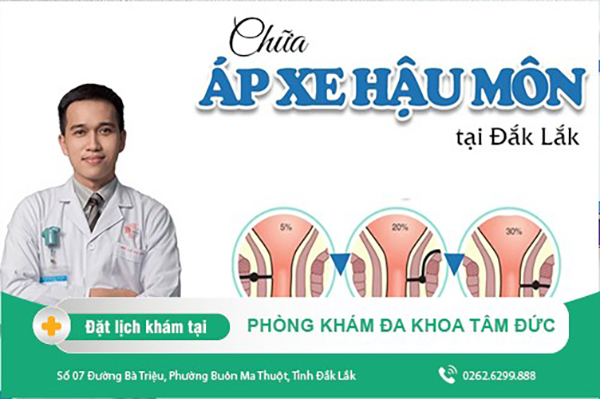 Chữa áp xe hậu môn tại Đắk Lắk