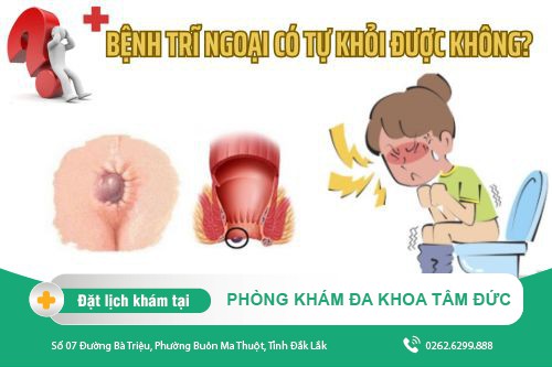 Bệnh trĩ ngoại có tự khỏi được không? Cách điều trị ra sao?