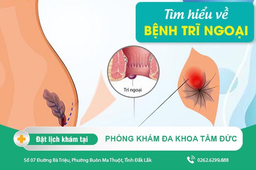 Triệu chứng bệnh trĩ ngoại là gì? Cách điều trị ra sao?