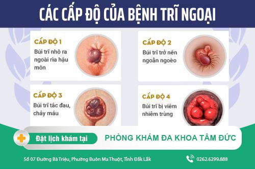 Chữa trĩ ngoại như thế nào cho hiệu quả? Chi phí hết bao nhiêu?