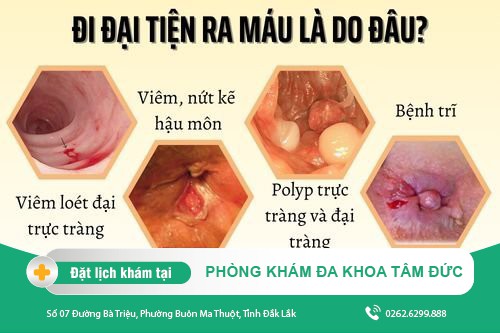 Đi Đại Tiện Ra Máu Do Đâu? Nguy Hiểm Như Thế Nào?