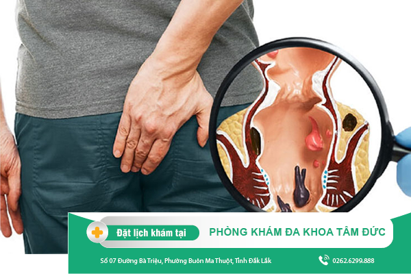 Tổng quan về tình trạng áp xe hậu môn