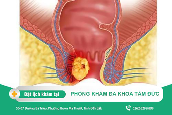 Tìm hiểu về mổ áp xe hậu môn chi tiết