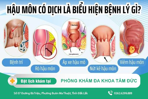 Hậu môn có dịch là biểu hiện bệnh gì? Cách điều trị ra sao?