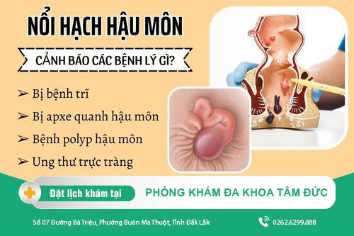 Nổi hạch hậu môn nguy cơ mắc phải bệnh gì? Cách điều trị ra sao?
